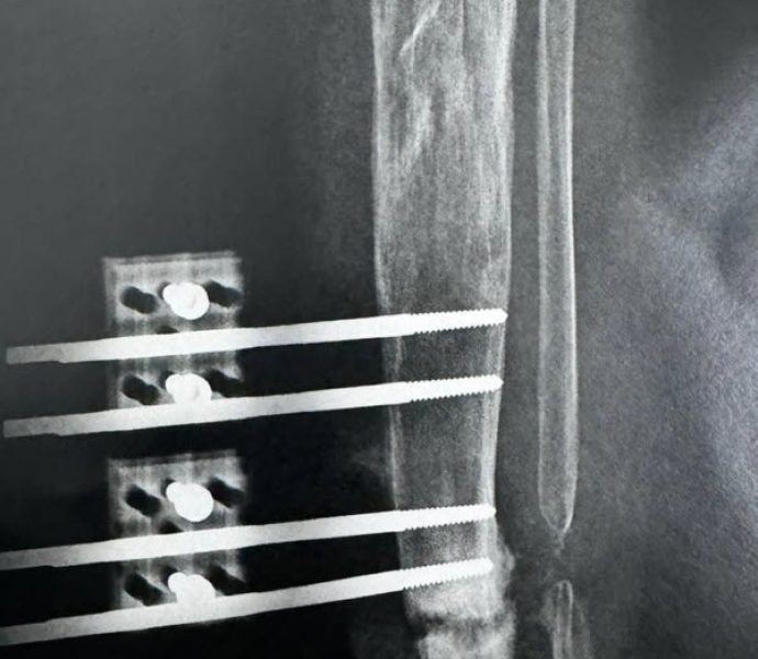 radiografias 1 año despues de iniciar alargamiento 1