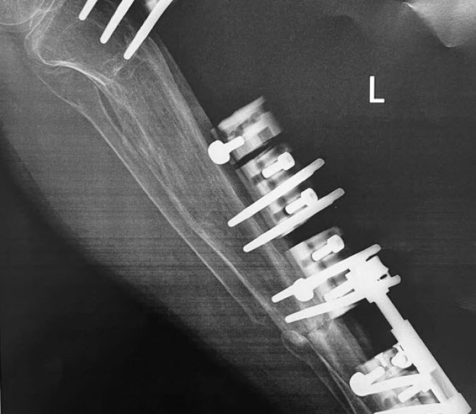 radiografias 1 año despues de iniciar alargamiento 2