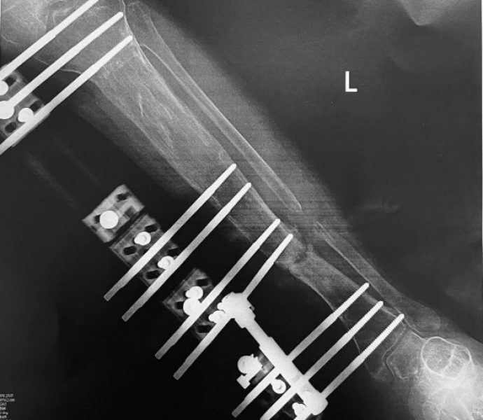 radiografias 1 año despues de iniciar alargamiento 3